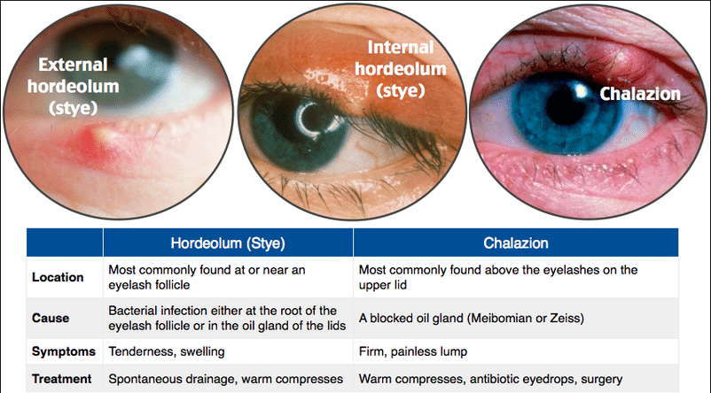 Eye Diseases | Advanced Surgical Mobile Eye Care